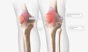 Comparaison de genoux : un sain et un affecté par la polyarthrite rhumatoïde, montrant la destruction du cartilage, de l'os et l'épaississement de la membrane synoviale.