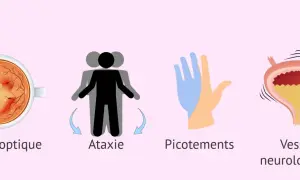 Symptômes de la sclérose en plaques : névrite optique, ataxie, picotements et vessie neurologique.