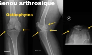 Radiographies d'un genou arthrosique montrant des ostéophytes. Le renforcement musculaire genou arthrose peut aider à gérer ces symptômes.