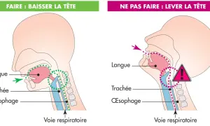 Illustration montrant comment éviter une fausse route chez une personne âgée : baisser la tête pour que la nourriture aille dans l'œsophage et non la trachée.