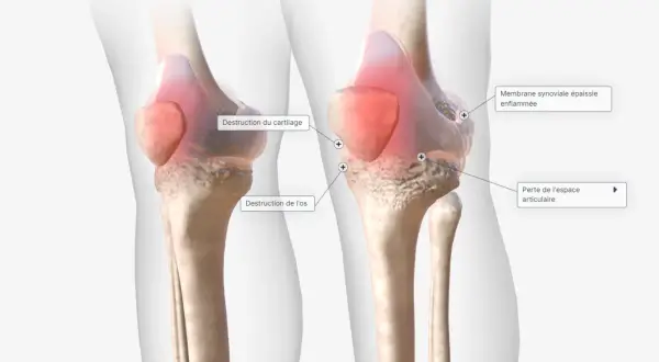Comparaison de genoux : un sain et un affecté par la polyarthrite rhumatoïde, montrant la destruction du cartilage, de l'os et l'épaississement de la membrane synoviale.