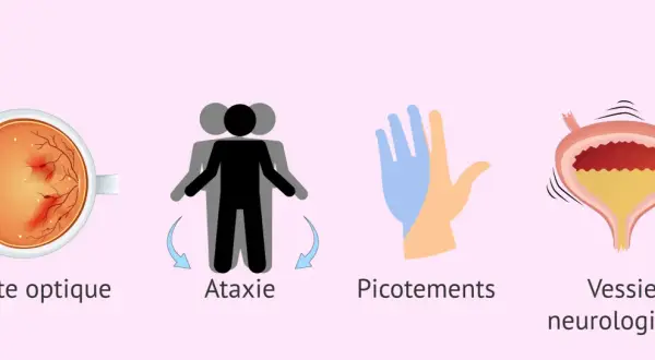 Symptômes de la sclérose en plaques : névrite optique, ataxie, picotements et vessie neurologique.