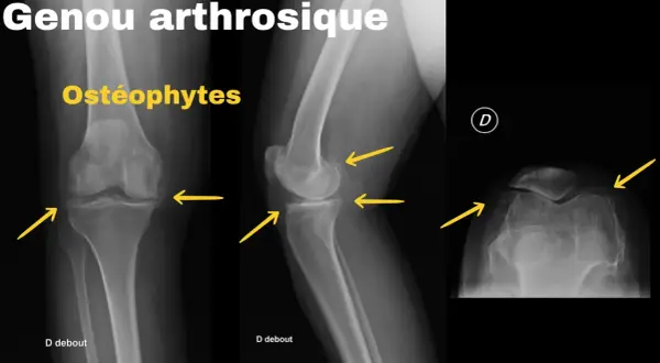 Radiographies d'un genou arthrosique montrant des ostéophytes. Le renforcement musculaire genou arthrose peut aider à gérer ces symptômes.
