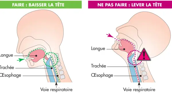 Illustration montrant comment éviter une fausse route chez une personne âgée : baisser la tête pour que la nourriture aille dans l'œsophage et non la trachée.