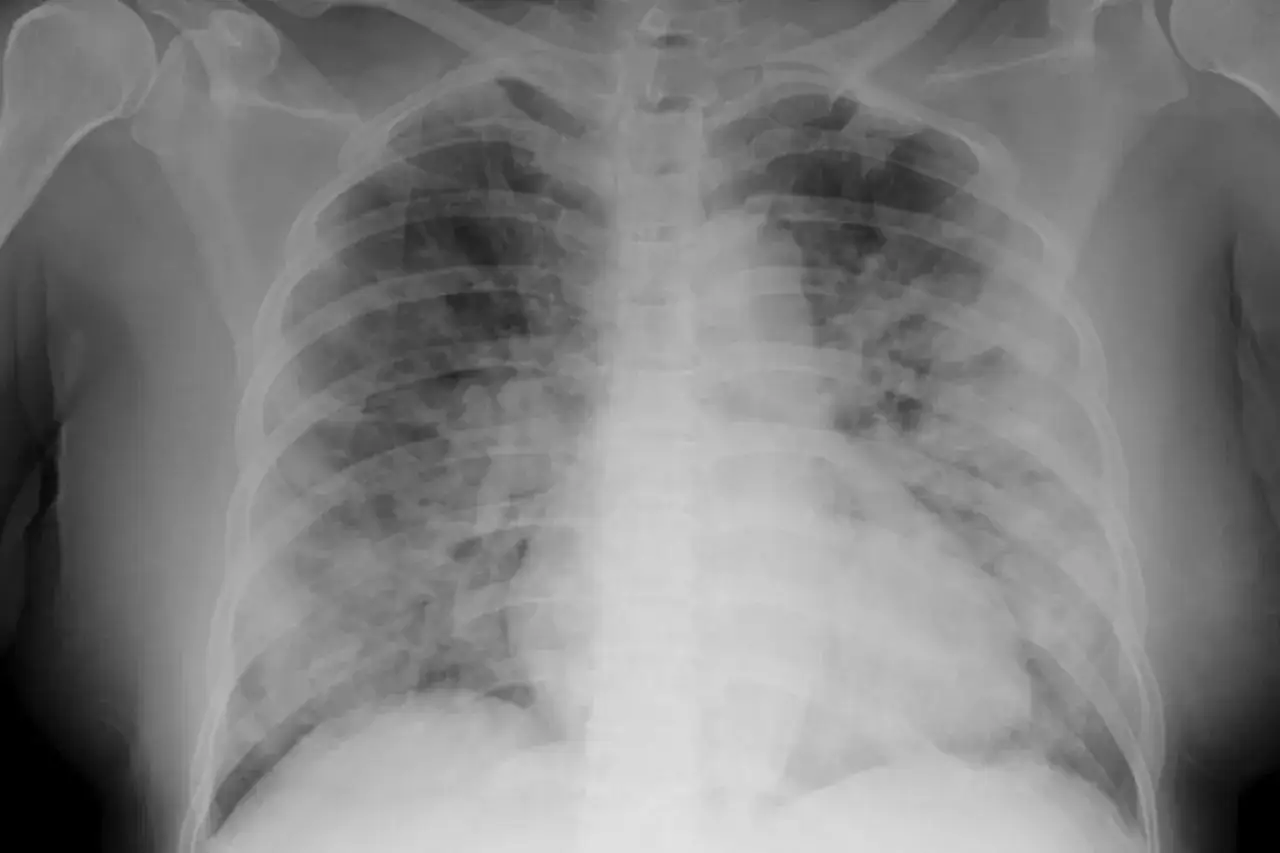 Radiographie pulmonaire montrant une infection pulmonaire avec des opacit&eacute;s diffuses, n&eacute;cessitant un traitement rapide.