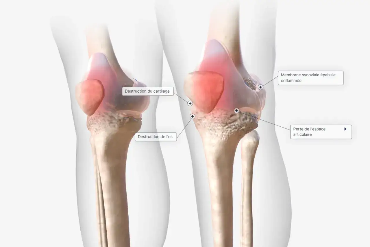 Comparaison de genoux : un sain et un affect&eacute; par la polyarthrite rhumato&iuml;de, montrant destruction du cartilage, de l'os, et perte d'espace articulaire.
