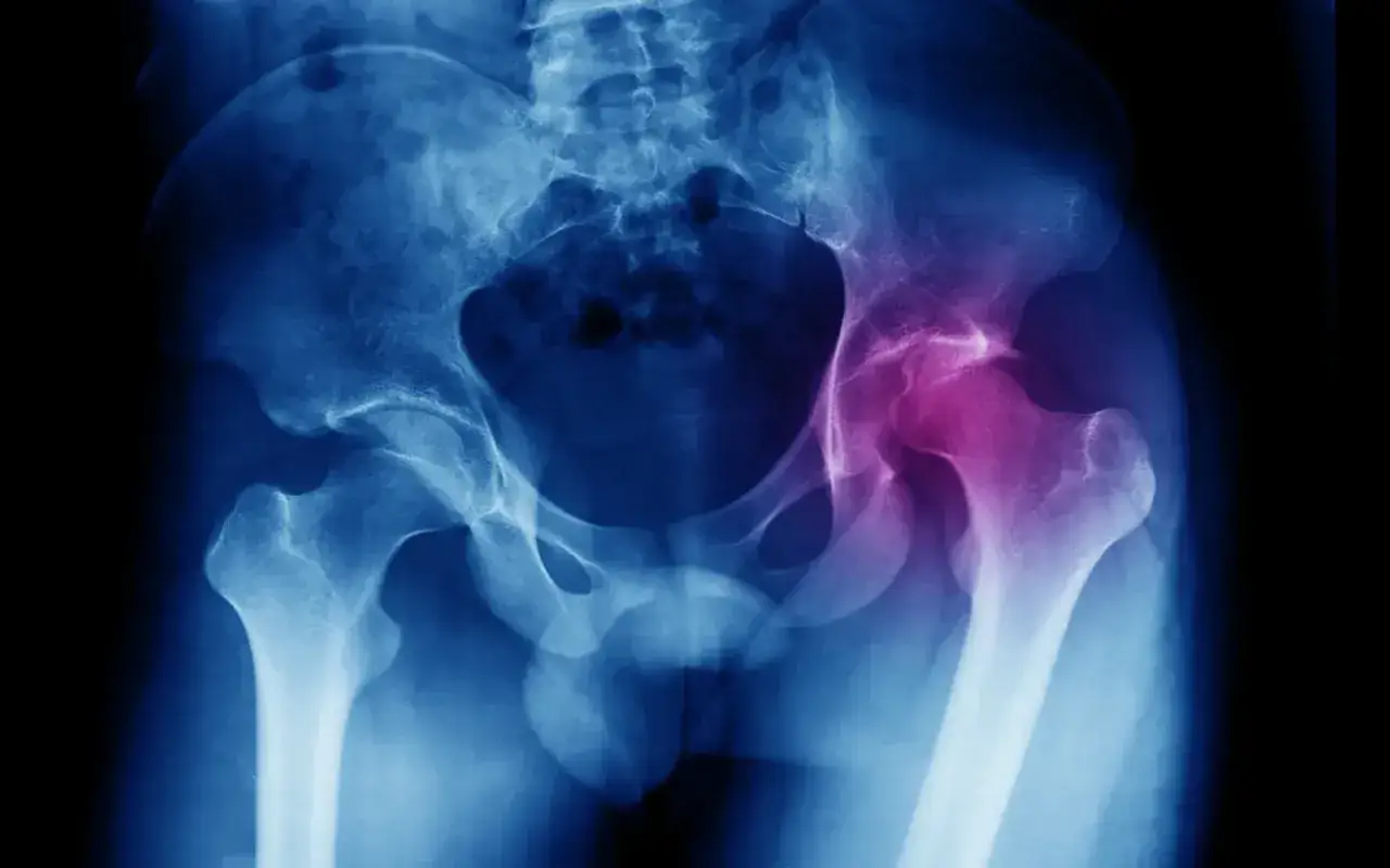 Radiographie du bassin montrant une fracture du col du fémur, une blessure qui peut affecter l'espérance de vie après une fracture du col du fémur.
