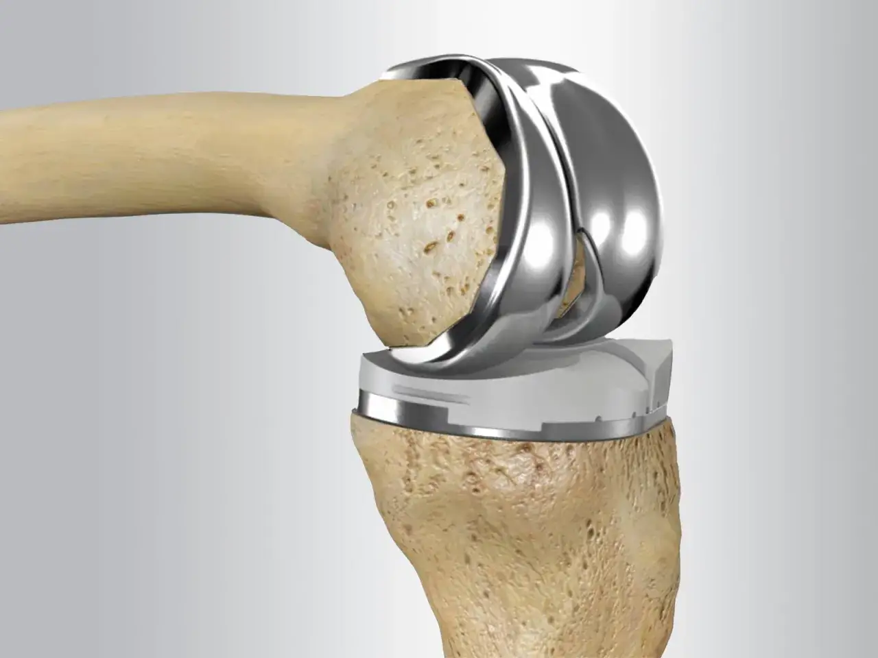 Proth&egrave;se de genou rempla&ccedil;ant une articulation endommag&eacute;e par la polyarthrite rhumato&iuml;de.