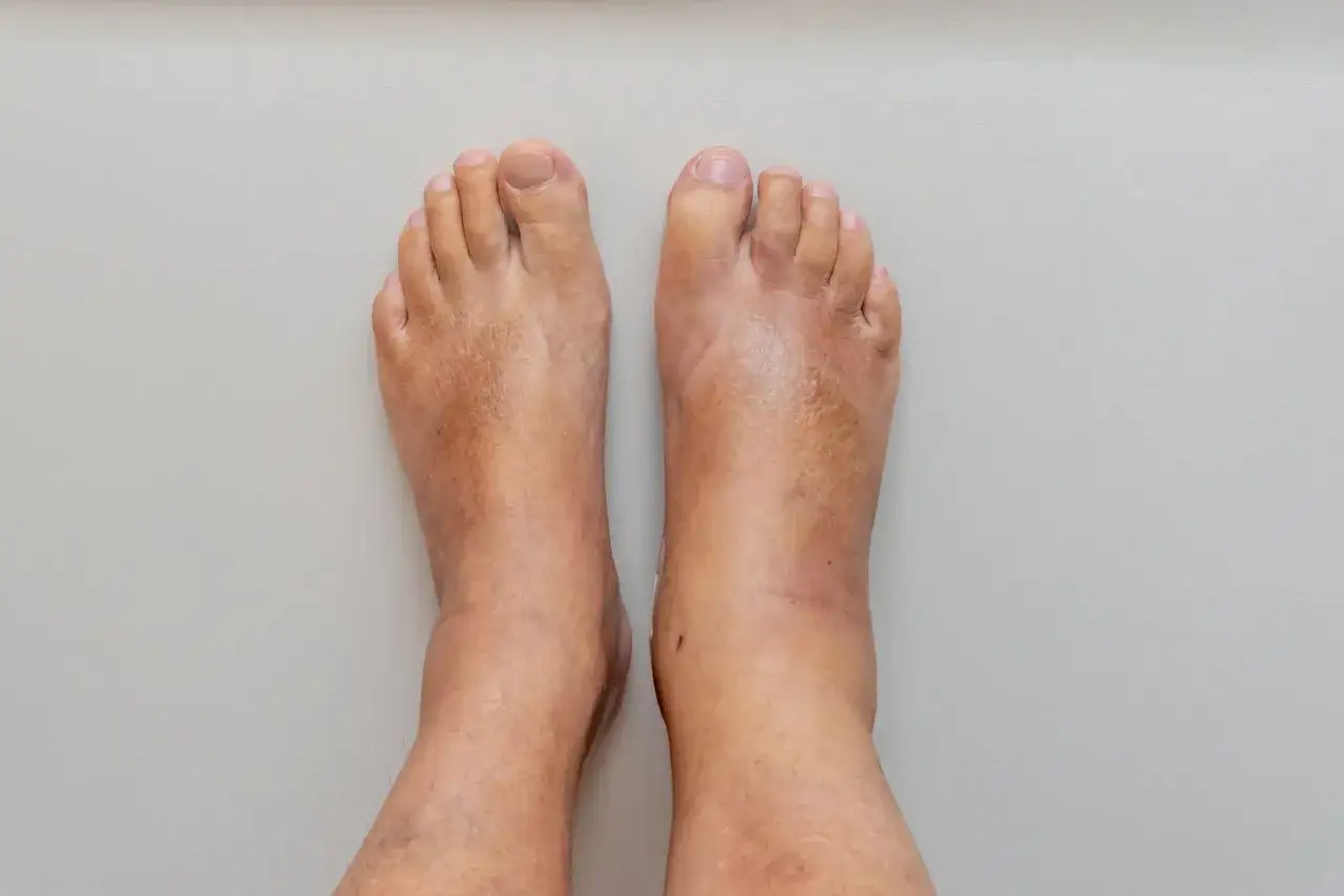 Pieds enflés, un symptôme possible d'insuffisance cardiaque. L'œdème des chevilles et des pieds peut indiquer une rétention d'eau.