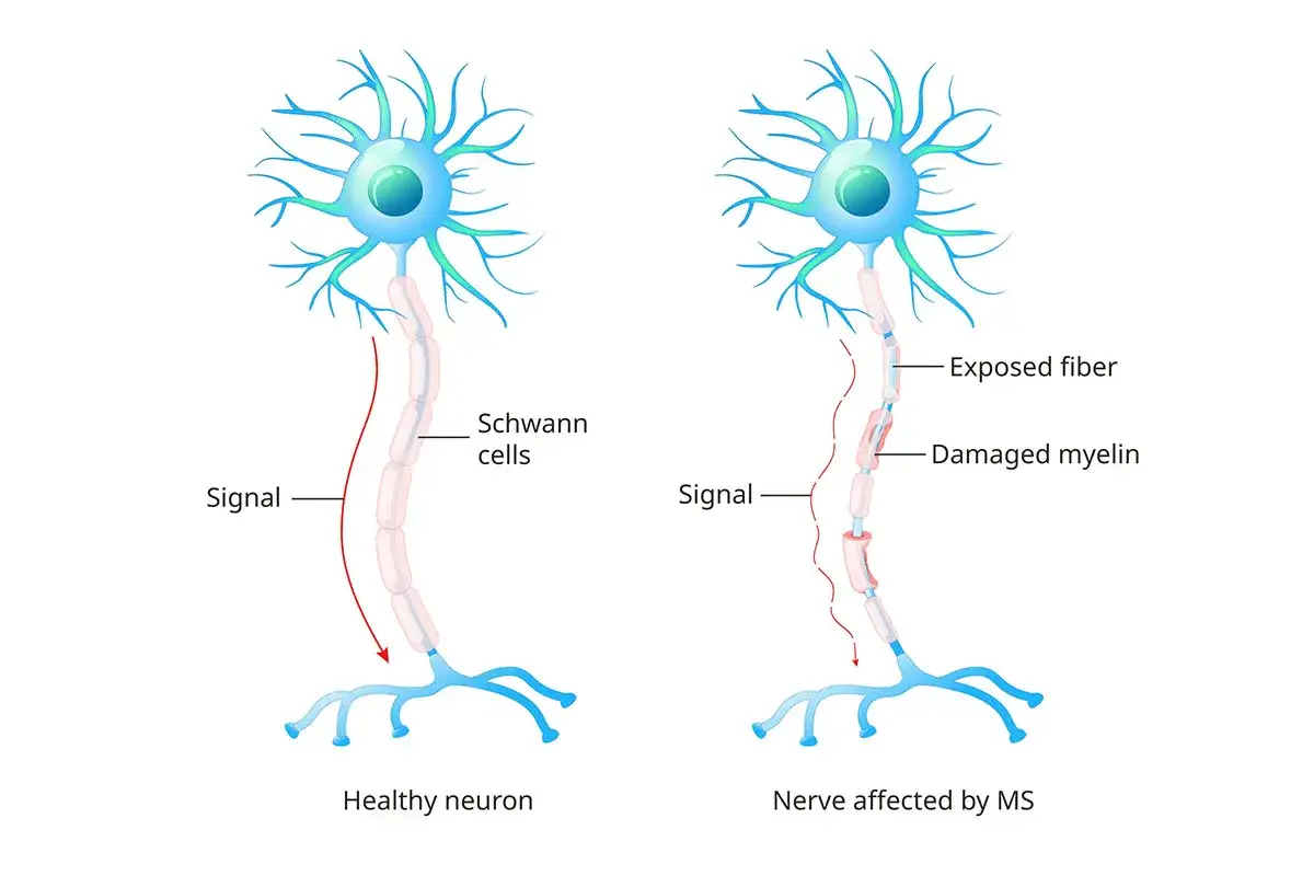 Comparaison d'un neurone sain et d'un nerf affecté par la sclérose en plaques. La myéline est endommagée, exposant la fibre nerveuse.