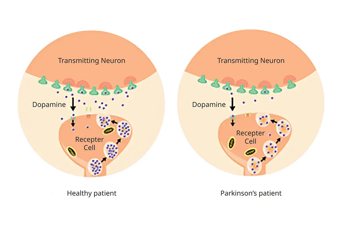 Sch&eacute;ma comparant la transmission neuronale chez un patient sain et un patient atteint de Parkinson, illustrant la diminution de dopamine. Le parkinson cause psychologique est complexe.