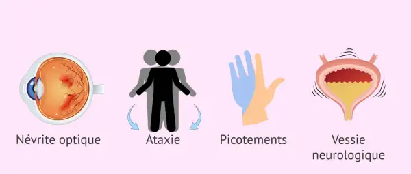 Symptômes de la sclérose en plaques : névrite optique, ataxie, picotements et vessie neurologique.