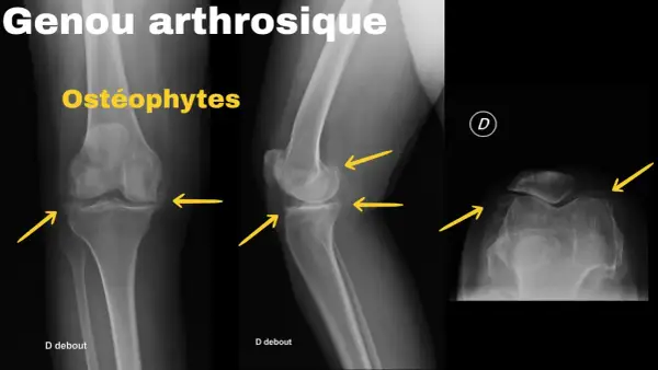 Radiographies d'un genou arthrosique montrant des ostéophytes. Le renforcement musculaire genou arthrose peut aider à gérer ces symptômes.