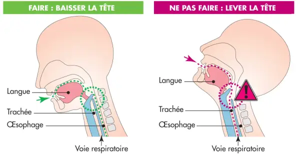 Illustration montrant comment éviter une fausse route chez une personne âgée : baisser la tête pour que la nourriture aille dans l'œsophage et non la trachée.